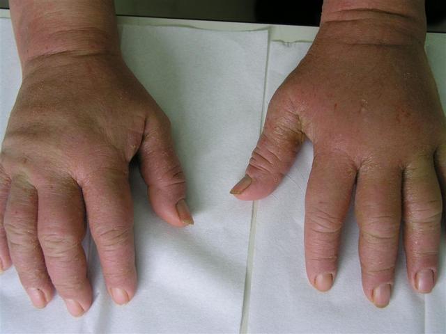 DERMATITIS - EKZEMA - Dermatitis