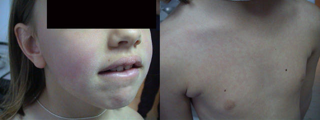 VIRAL INFECTIONS - Toxic erythema VIRAL INFECTIONS - Toxic erythema