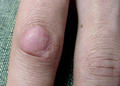 VARIOUS or of UNKNOWN ETIOLOGY DISEASES - Knuckle Pads