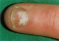 NAIL DISEASES - Onychomycosis