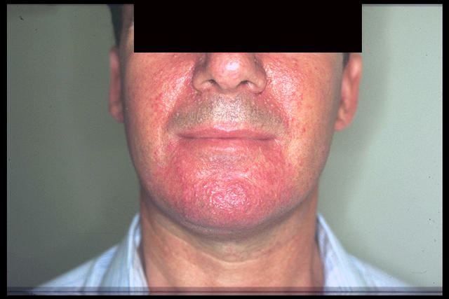 GENODERMATOSES - Tuberous sclerosis complex (Bourneville's disease), adenomata seborrheic GENODERMATOSES - Tuberous sclerosis complex (Bourneville's disease), adenomata seborrheic
