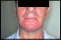 GENODERMATOSES - Tuberous sclerosis complex (Bourneville