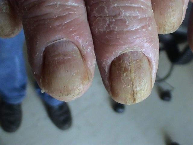 PSORIASIS - Psoriatic nails PSORIASIS - Psoriatic nails