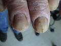 PSORIASIS - Psoriatic nails