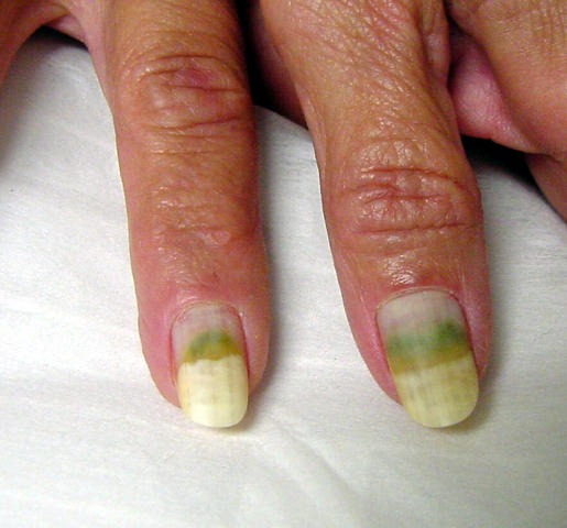 NAIL DISEASES - Pseudomonas aeruginosa infection of the nail