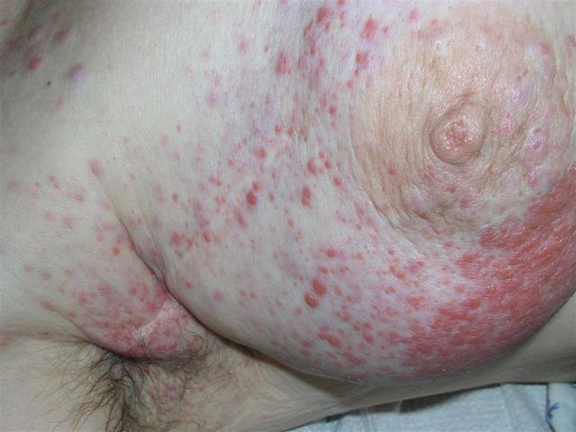 METASTATIC LESIONS - Cutaneous lesions - Breast cancer