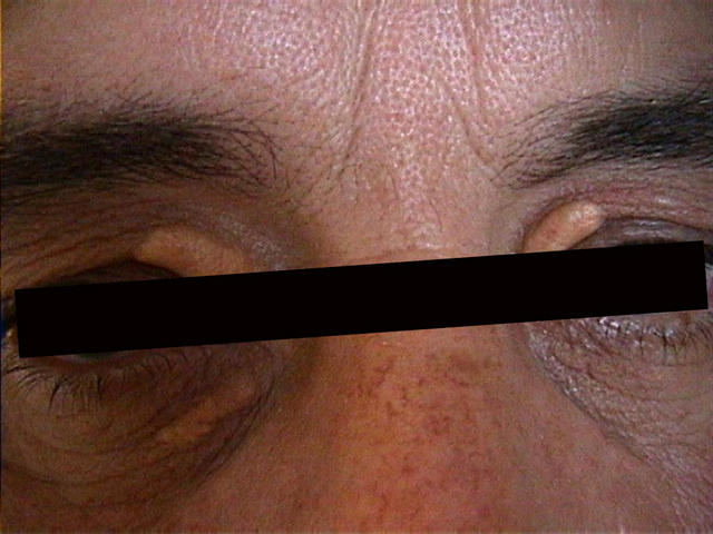 METABOLIC DISEASE, NUTRITION - Xanthelasma METABOLIC DISEASE, NUTRITION - Xanthelasma