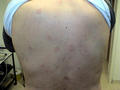 VARIOUS or of UNKNOWN ETIOLOGY DISEASES - Pityriasis rosea