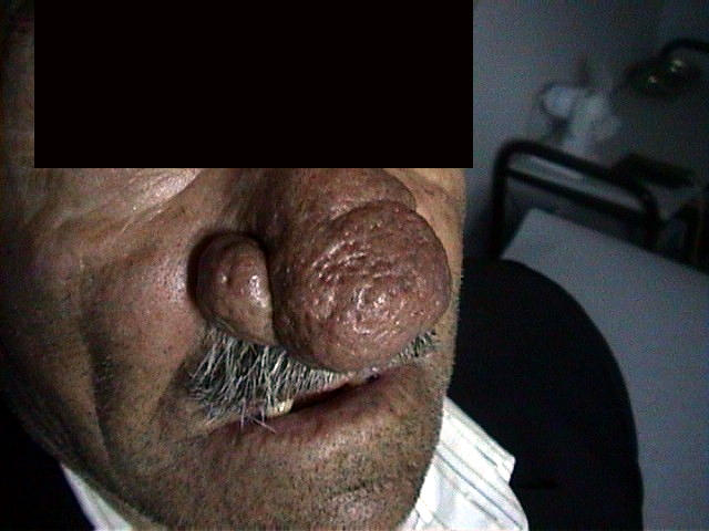 DISEASES OF THE SEBACEOUS GLANDS - Rhinophyma