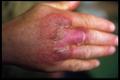 BACTERIAL INFECTIONS - Erysipeloid