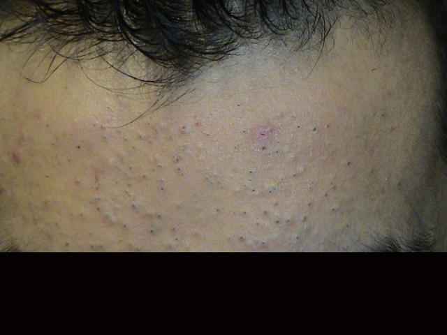 DISEASES OF THE SEBACEOUS GLANDS - Acne, Comedonal