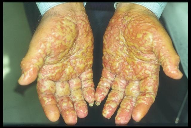 VARIOUS or of UNKNOWN ETIOLOGY DISEASES - Acropustulosis