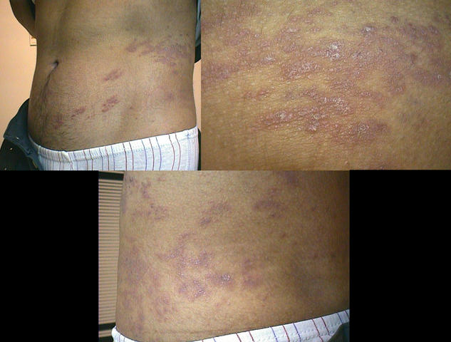 LICHEN - Lichen planus, annular LICHEN - Lichen planus, annular