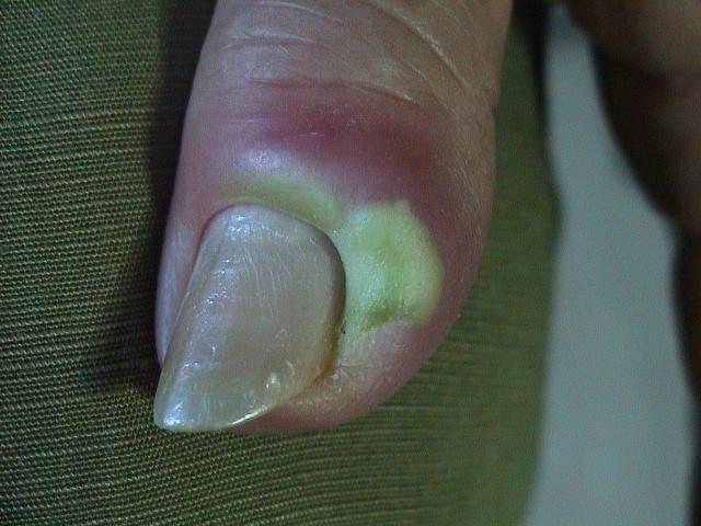 NAIL DISEASES - Acute paronychia NAIL DISEASES - Acute paronychia