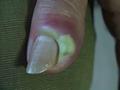 NAIL DISEASES - Acute paronychia