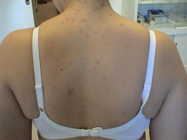 VIRAL INFECTIONS - SmallPox VIRAL INFECTIONS - SmallPox
