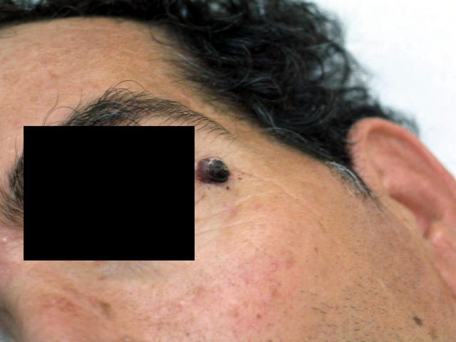 DISEASE OF THE BLOOD AND THE VESSELS – PURPURAS - Spider Nevus