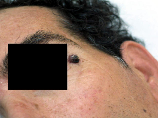 DISEASE OF THE BLOOD AND THE VESSELS – PURPURAS - Spider Nevus DISEASE OF THE BLOOD AND THE VESSELS – PURPURAS - Spider Nevus