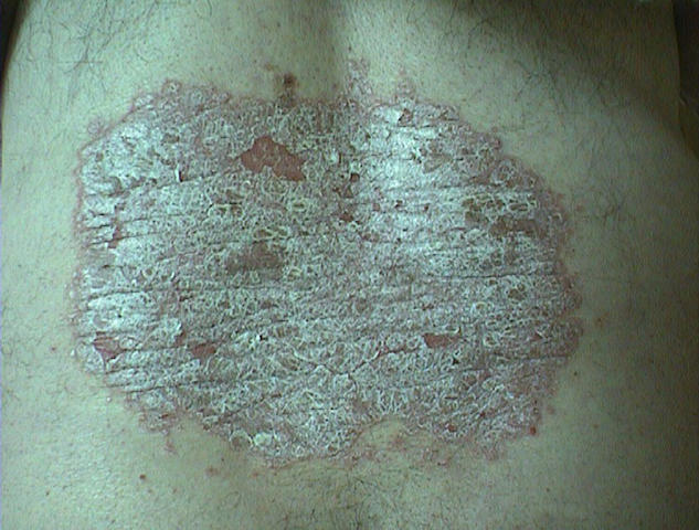 PSORIASIS - Psoriasis