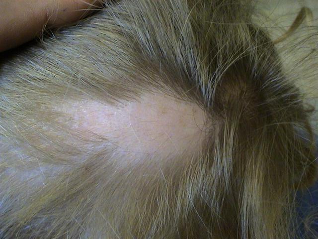 HAIR DISEASES - Alopecia Areata