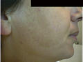 PIGMENTATION DISORDERS - Melasma