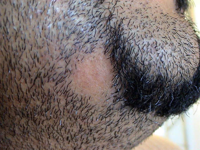 HAIR DISEASES - Alopecia Areata HAIR DISEASES - Alopecia Areata