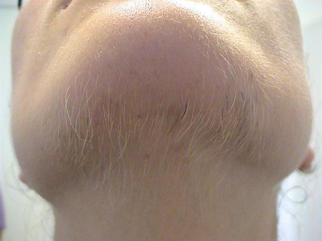 HAIR DISEASES - Hirsutism HAIR DISEASES - Hirsutism