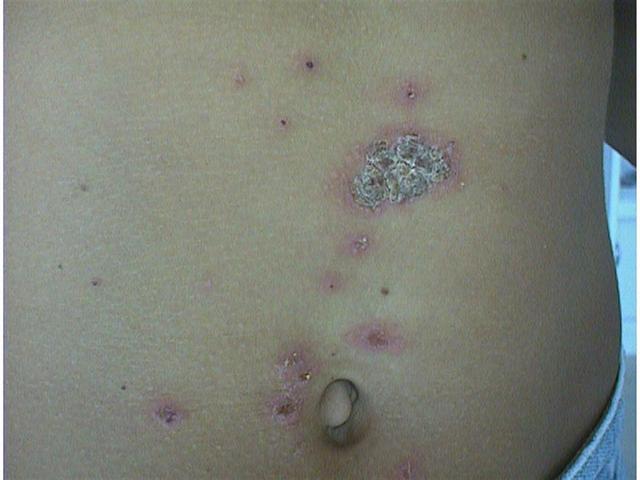 BACTERIAL INFECTIONS - Impetigo