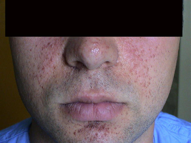 GENODERMATOSES - Tuberous sclerosis complex (Bourneville's disease), adenomata seborrheic