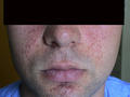 GENODERMATOSES - Tuberous sclerosis complex (Bourneville