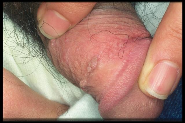 VIRAL INFECTIONS - Condylomata acuminata VIRAL INFECTIONS - Condylomata acuminata