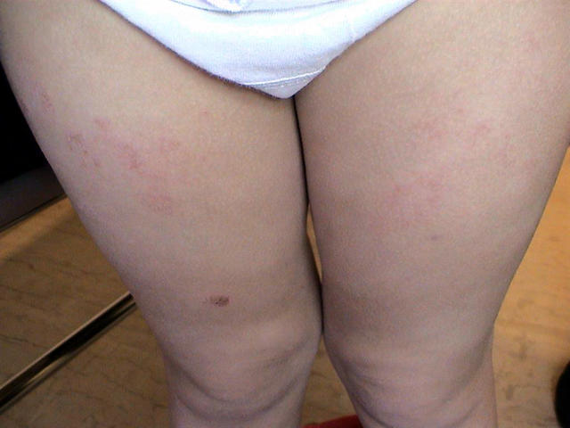 DERMATITIS - EKZEMA - Atopic dermatitis DERMATITIS - EKZEMA - Atopic dermatitis