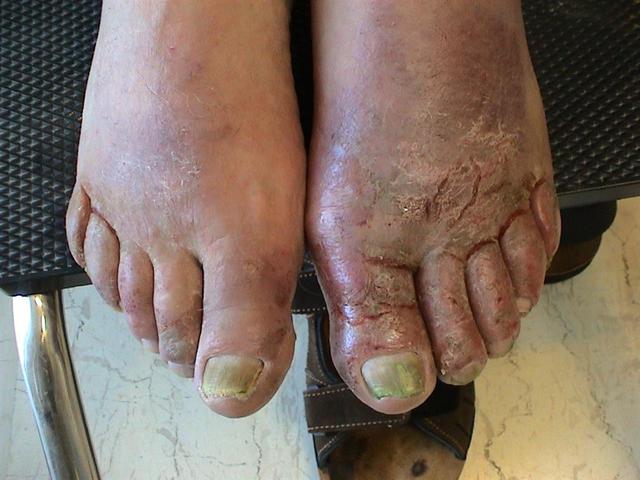 NAIL DISEASES - Onychomycosis