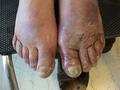 NAIL DISEASES - Onychomycosis