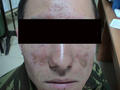 DERMATITIS - EKZEMA - Seborrheic Dermatitis