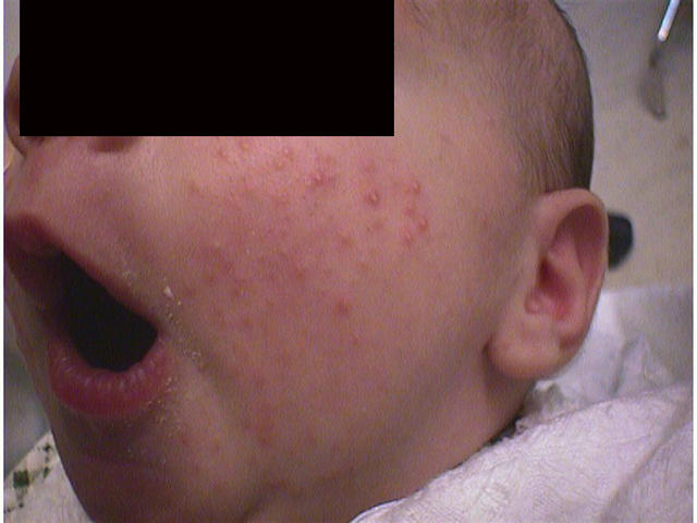 DISEASES OF THE SEBACEOUS GLANDS - Acne infantile