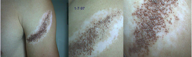 PIGMENTATION DISORDERS - Vitiligo