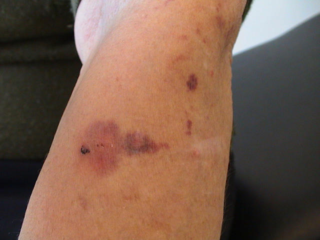 DRUG ERUPTIONS - Ecchymoses due to topical corticosteroids