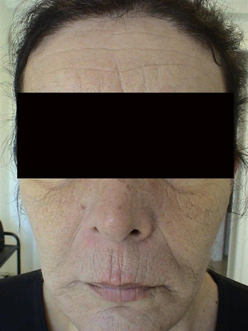 CONNECTIVE TISSUE DISORDERS - Photoaging CONNECTIVE TISSUE DISORDERS - Photoaging