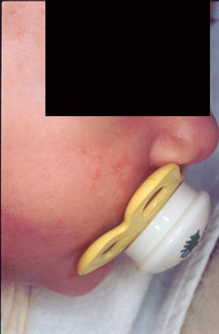 DISEASES OF THE SEBACEOUS GLANDS - Acne infantile