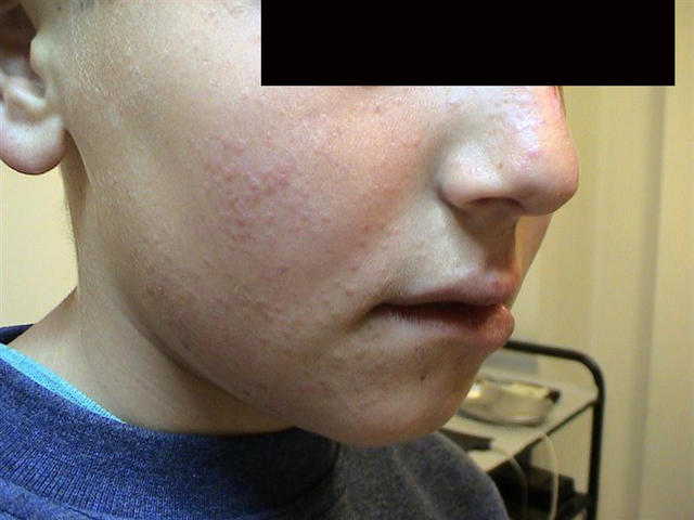 VIRAL INFECTIONS - Warts VIRAL INFECTIONS - Warts