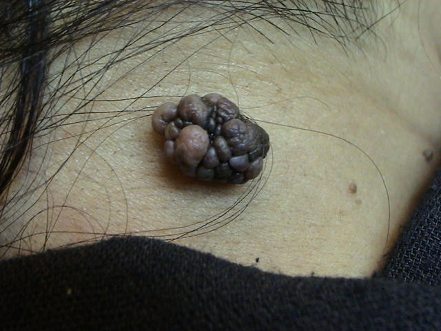 BENIGN SKIN LESIONS, NEVI, CYSTS - Acrochordon (Skin Tag)