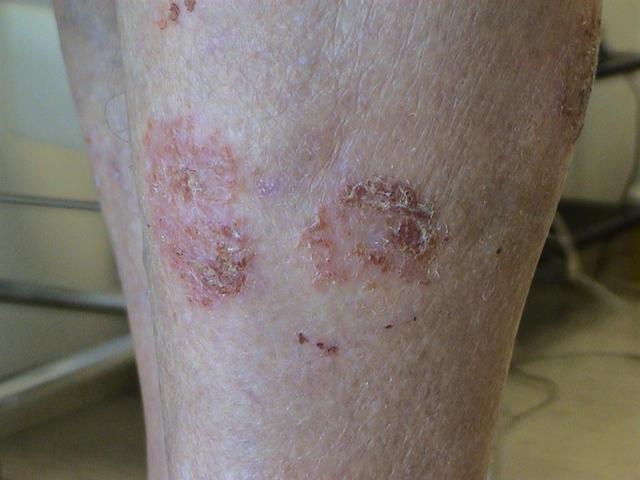 DERMATITIS - EKZEMA - Nummular eczema DERMATITIS - EKZEMA - Nummular eczema