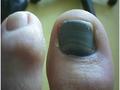 NAIL DISEASES - Traumatic melanonychia