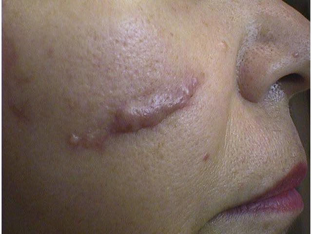 SOFT TISSUE TUMORS - Cheloid SOFT TISSUE TUMORS - Cheloid