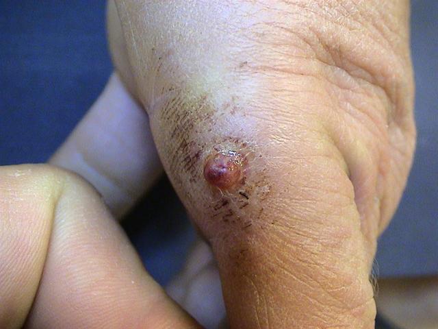 DISEASE OF THE BLOOD AND THE VESSELS – PURPURAS - Pyogenic granuloma