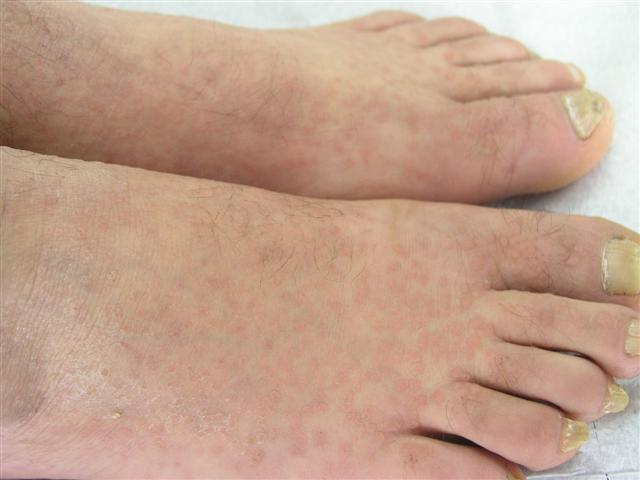 GENODERMATOSES - Acrokeratosis verruciformis of Hopf