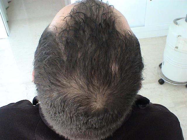 HAIR DISEASES - Androgenetic alopecia