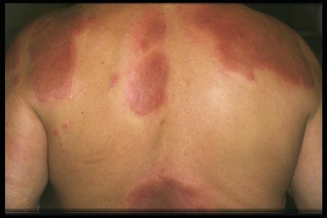 VARIOUS or of UNKNOWN ETIOLOGY DISEASES - Cellulitis eosinophilic (Well's syndrome)