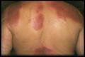VARIOUS or of UNKNOWN ETIOLOGY DISEASES - Cellulitis eosinophilic (Well